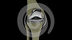 Human knee with knee replacement isolated on a black background 4k video