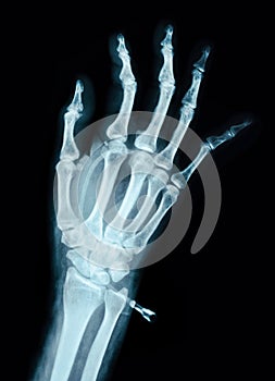 Human Left hand on device x ray.