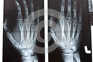 Human left hand xray image