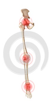 Human leg bones with joints affected by arthritis