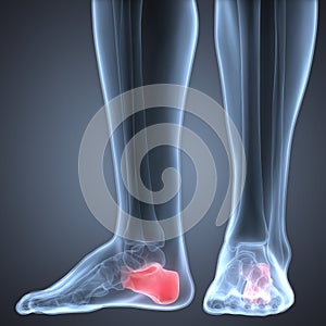 Human Leg Joint Pains (Calcaneus Bone)