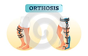 Human leg orthosis medical equipment vector illustration.