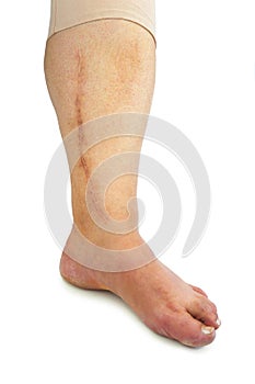 Human leg with postoperative scar of cardiac surgery photo