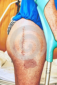 Human leg with postoperative scar of joint surgery. Detail of skin
