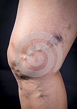 Human leg with varicose veins