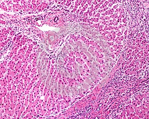 Human liver. Cirrhosis