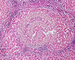 Human liver. Cirrhosis