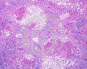 Human liver. Cirrhosis and steatosis