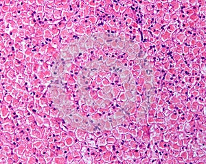 Human liver. Glycogenosis