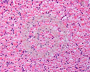Human liver. Glycogenosis photo