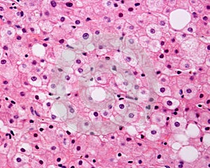 Human liver. Steatosis