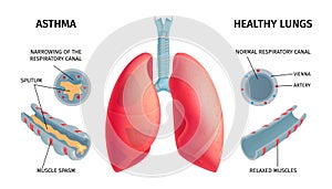 Human Lung Anatomy Infochart photo