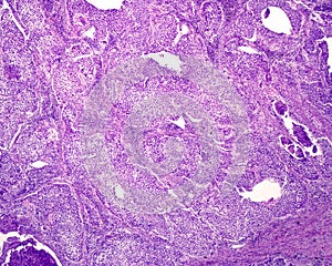 Human lung carcinoma
