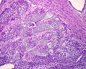 Human lung carcinoma