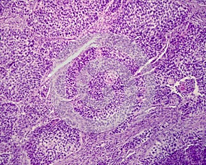 Human lung carcinoma