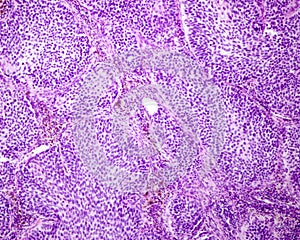 Human lung carcinoma