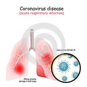 Human lungs are attacked by coronavirus