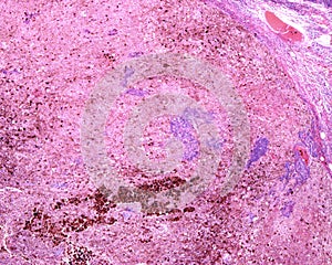 Human lymph node. Metastasis of malignant melanoma