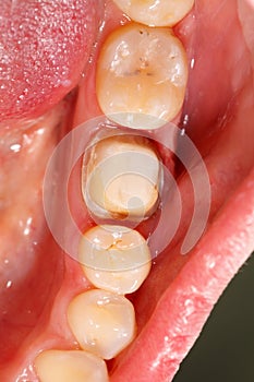 Molar Prepared For Dental Crown photo