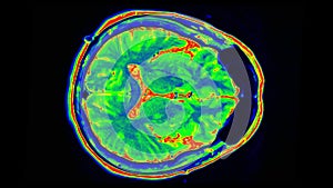 Human MRI brain scan on black background. Computed tomography of the human brai