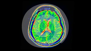 Human MRI brain scan on black background. Computed tomography of the human brai