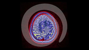 Human MRI brain scan on black background. Computed tomography of the human brai