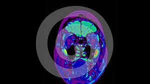 Human MRI brain scan on black background. Computed tomography of the human brai