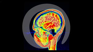 Human MRI brain scan on black background. Computed tomography of the human brai