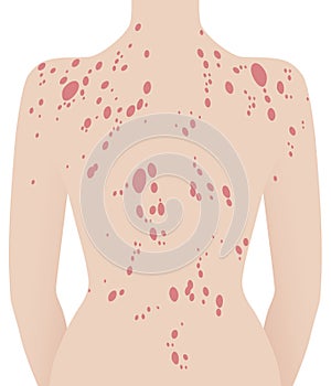 Human neck and back with psoriasis