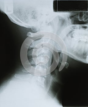 Human Neck Xray
