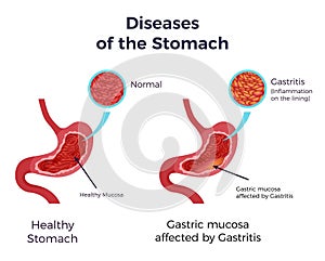 Human normal stomach compared to gastritis affected swollen inflamed mucosa lining flat set infographic poster illustration