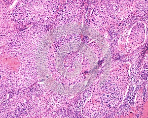 Human ovary carcinoma