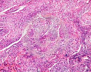 Human ovary carcinoma