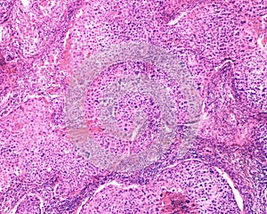 Human ovary carcinoma