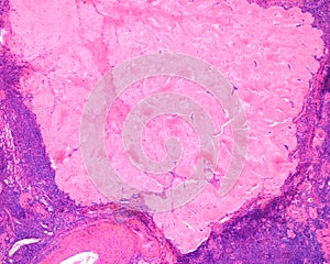 Human ovary. Corpus albicans photo