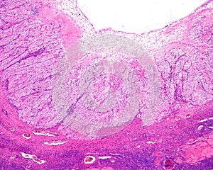 Human ovary. Regression of corpus luteum