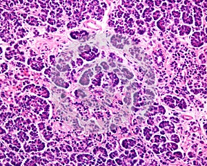 Human pancreas. Type 2 diabetes mellitus