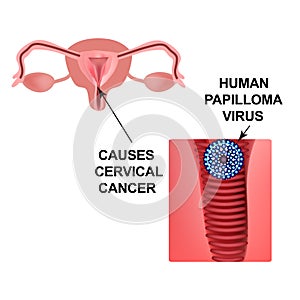 Human Papilloma Virus. Causes cervical cancer. The structure of the pelvic organs. Infographics. Vector illustration on