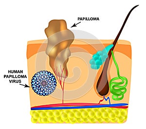 Human Papilloma Virus causes the formation of papillomas on the skin. Structure. Infographics. Vector illustration on