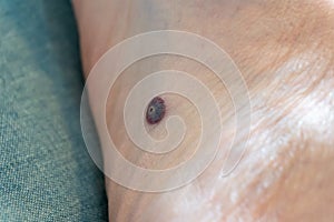 Human papillomavirus infection HPV of a plantar wart, treated with liquid nitrogen cryotherapy wart freezing as a medical photo