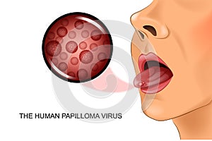 The human papillomavirus on tongue