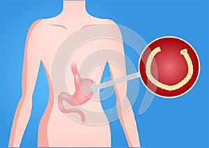 Human Parasite in human stomach vector