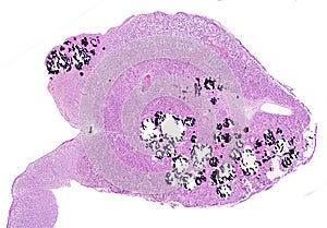 Human pineal gland. Calcareous concretions