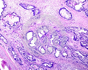 Human prostate cancer. Adenocarcinoma photo