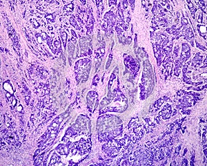 Human prostate cancer. Adenocarcinoma photo