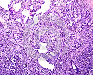 Human prostate cancer. Adenocarcinoma photo