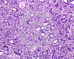 Human prostate cancer. Adenocarcinoma photo