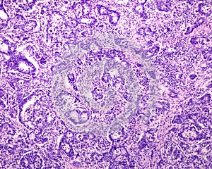 Human prostate cancer. Adenocarcinoma photo