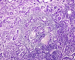 Human lymph node. Reticulosarcoma photo