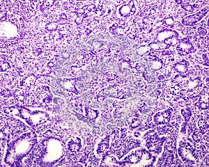 Human prostate cancer. Adenocarcinoma photo
